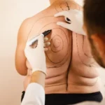 Understanding Difference Between Liposuction and Liposculpture