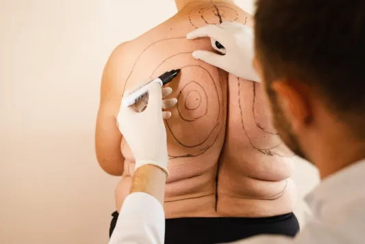 Understanding Difference Between Liposuction and Liposculpture