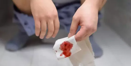 Simple Home Tips to Treat Hemorrhoids Naturally